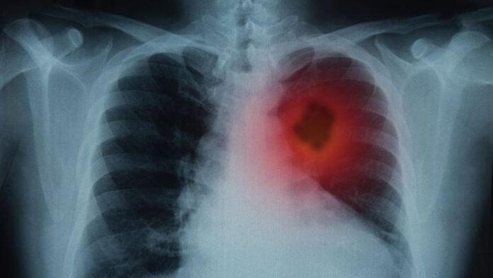 'Covid'i ağır geçirenlerde kalıcı akciğer hasarı riski daha yüksek'